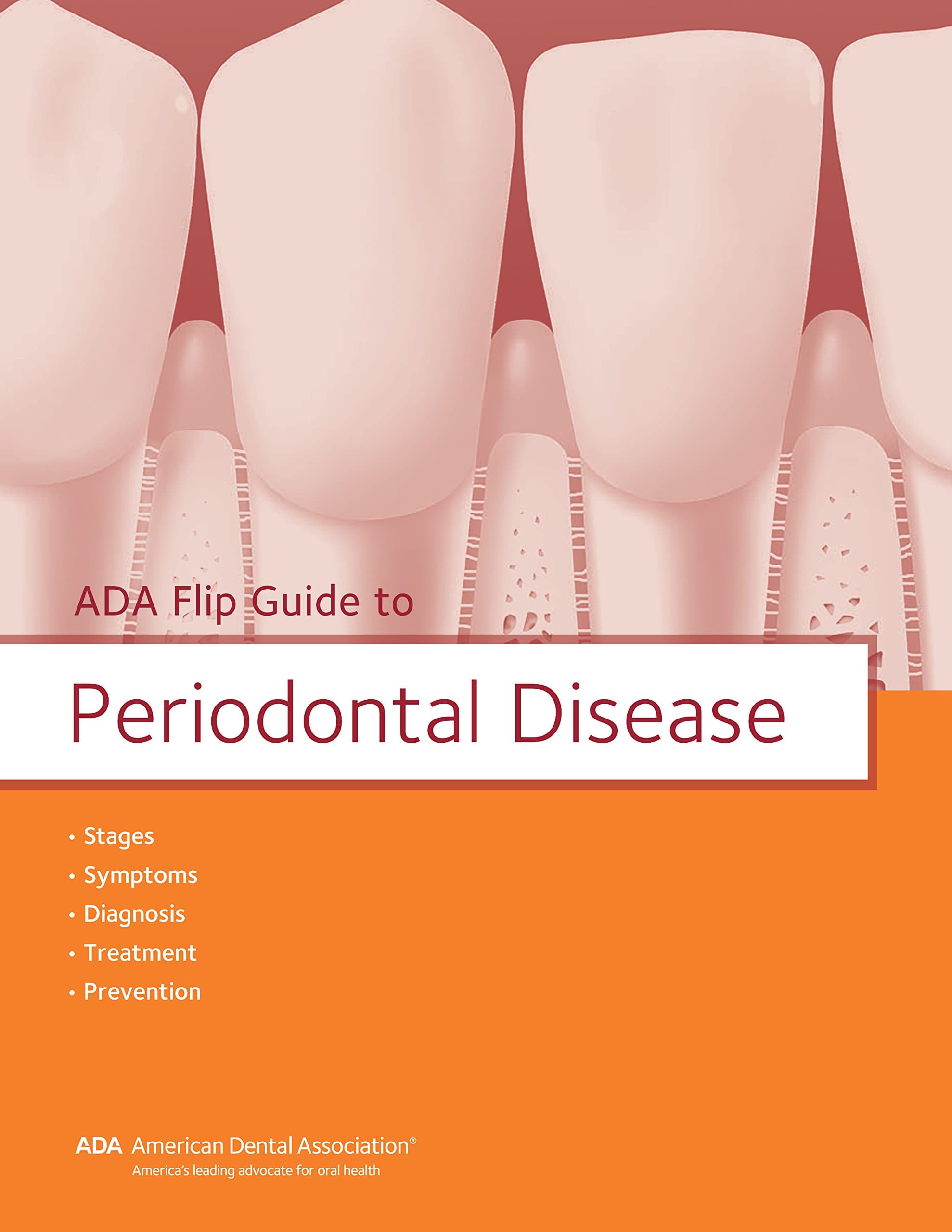 ADA Flip Guide to Periodontal Disease Spiral-bound – September 1, 2017