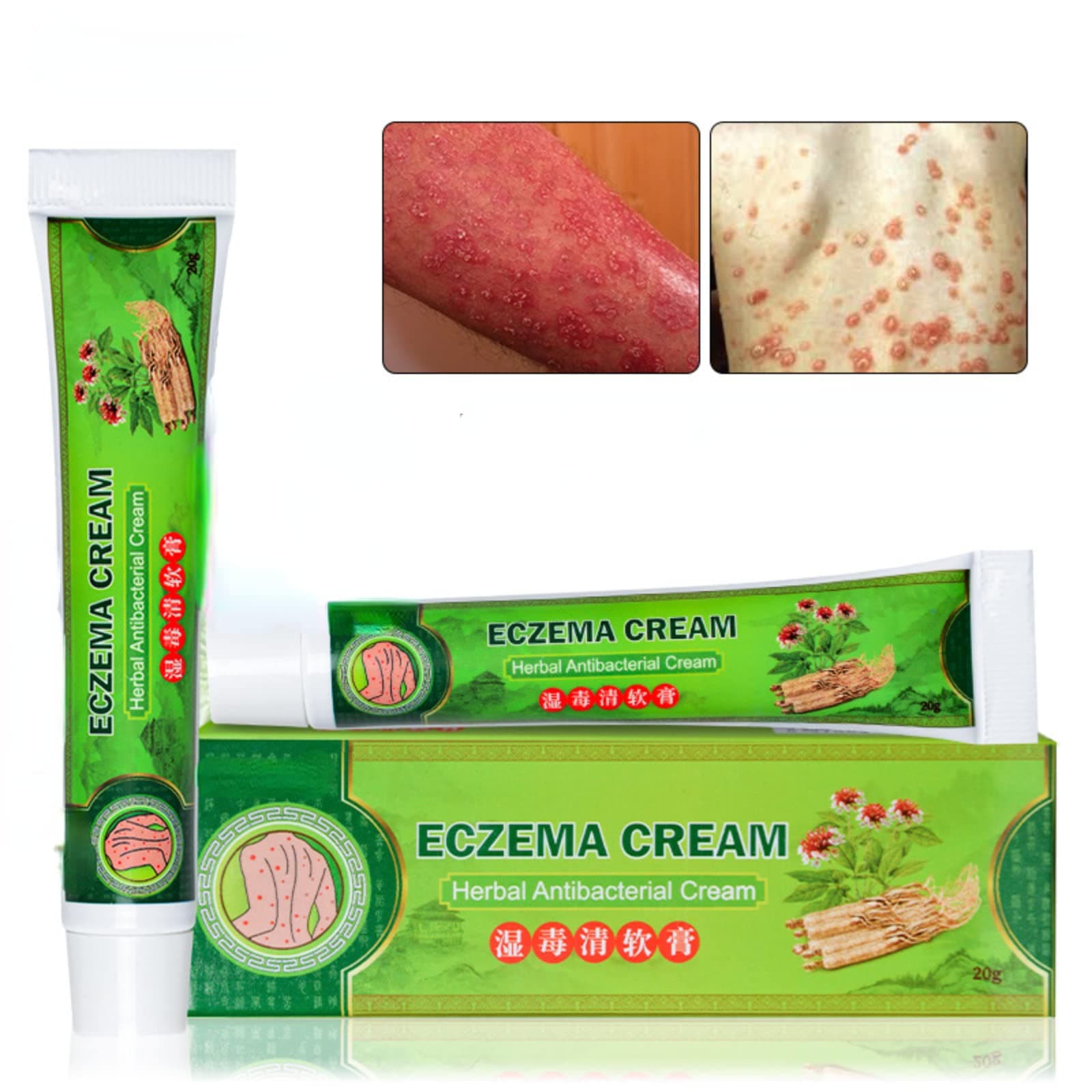 2 pcs Chinese Herbal Eczema, Psoriasis Creams Dermatitis and Eczema Pruritus Psoriasis Ointment
